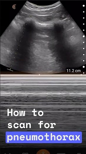 Lung Sliding Ultrasound