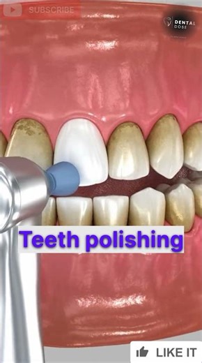 Tooth polishing #dentalcare #dentalclinic #dentalprosthesis #dentalcare #teethwhitening #polishing