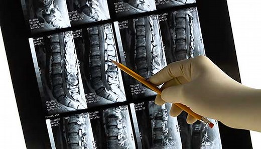 Spondyloepiphyseal Dysplasia Congenita