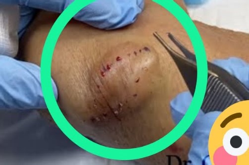 Epidermal Cyst Removal