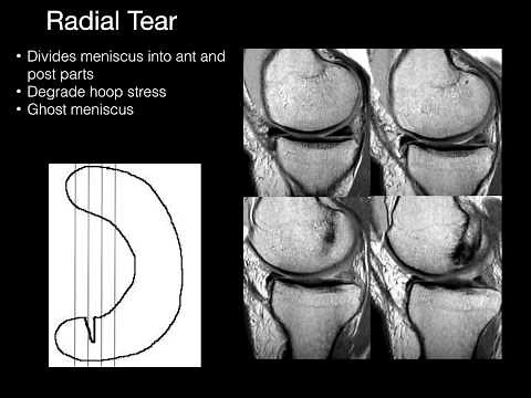 Presentation On Knee Menisci - Anatomy And MRI • Video • MEDtube.net