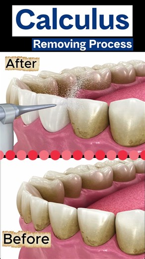 What exactly is dental calculus, and how is it different from plaque?