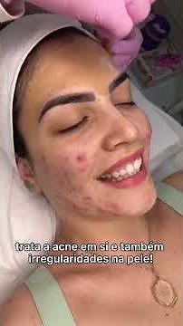 Transformação do Peeling com Ácido Retinóico