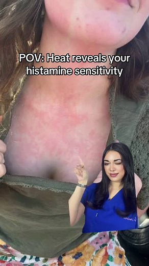 Heat & Histamine Sensitivity: Flushing, Itching, Hives Explained