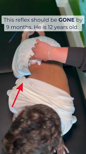 This is a 12 year old boy who came in for help with focus, posture, and bedwetting. His mom told me he's always moving, can't sit still through homework, and complains his back hurts when he sits at his desk. When I evaluated him, his Spinal Galant reflex was still active on both sides. The Spinal Galant is a reflex every baby is born with. When you stroke a newborn along the side of the spine, their hip swings toward that side. It is what helps a baby move through the birth canal and develop th