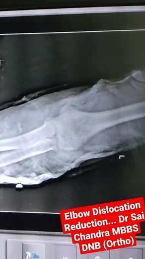 Elbow Dislocation Reduction..This video is only for educational purposes only... Dr Sai Chandra