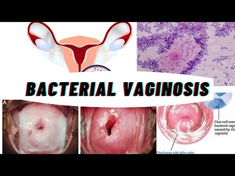 Bacteria vaginosis - causes, symptoms, prevention & treatment