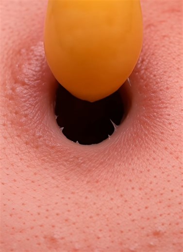 blackhead removal #pimples #blackhead #asmr #satisfyingvideo