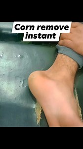 Corn remove instant by agnikarma process #reelsvideo #fbreels #health #viral #doctor #Royal | Vaidya Pawan Kaushik