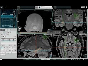 MRI Brain | Hippocampal Volume Analysis Explained 🧠 | Early Detection of Alzheimer’s & Memory Loss
