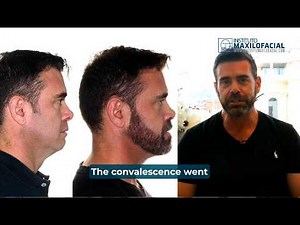 Bimaxillary Surgery Case #167: Colin- Sleep apnea, Maxillo-mandibular retrusion