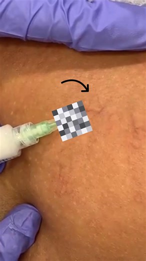 30 million Americans experience symptoms of vein disease: ❌ Leg Pain ❌ Aching ❌ Swelling ❌ Cramping ❌ Itching Experience the joy of healthy legs with state-of-the-art vein care! | Metro Vein Centers | Facebook