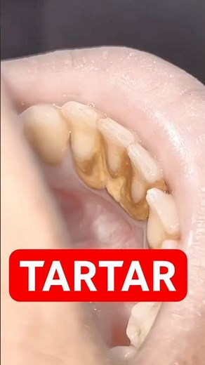 Satisfying Tartar Removal ASMR 🦷✨