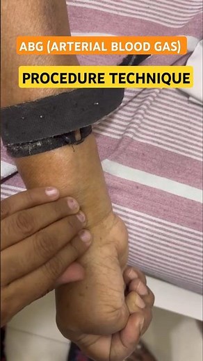 ABG Technique Radial Artery | ABG Blood Collection Procedure | ABG Sample Collection #shorts