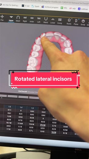 My biggest pet peeve is dentists who submit to Invisalign and the only instructions are to align the teeth. And then there is no modification. The results are just subpar. My tip for today is to segment movements for lateral incisors. If you try to rotate and extrude, that makes it more difficult. I recommend creating space, rotating and then extruding!