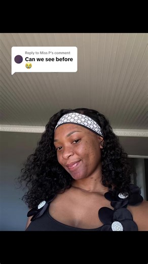 Coping with a Chemical Burn: My Healing Journey
