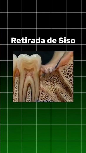 Seu siso pode estar assim 😲 #aviso #odontologia #curiosidades