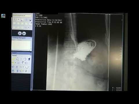 Radiology x ray cases online Library part 80 Esophagography Gastrography Irrigography Barium studies