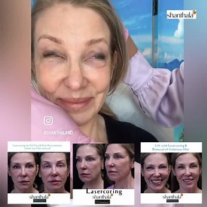 Reversal of under the eye fillers & lift with Lasercoring