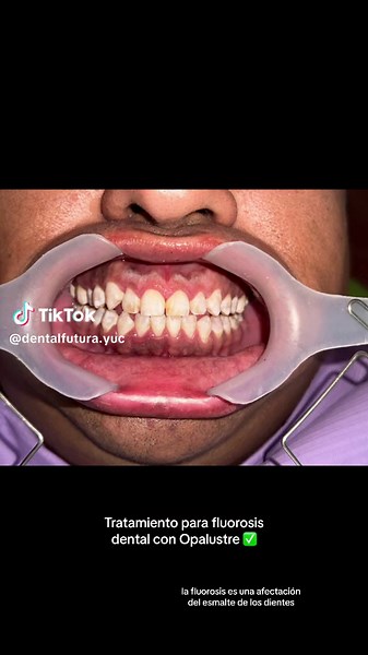 Tratamiento efectivo para fluorosis dental con Opalustre