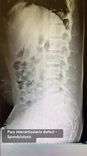 Spondylolysis - Pars interarticularis defect