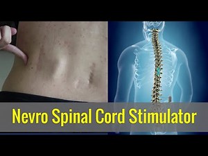What does the Nevro Spinal Cord Stimulator scar look like? | Young Chronic Pain