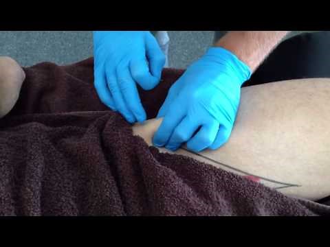 Dry Needling: Rectus Femoris