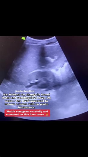 Expert in the house, comment diagnosis of the case! 🙃 #radschoolbro #sonographer #ultrasonographer #ultrasoundtech #sonography