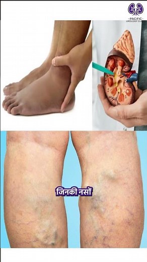 Renal Artery Stenosis (Part 2) | Causes, Symptoms, Diagnosis & Treatment