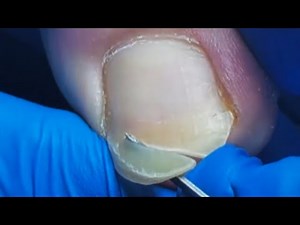 Silky Long Toenails Trimmed To Restore Healthy Toenails