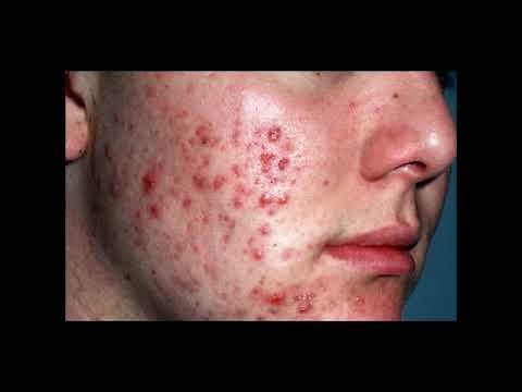 Akne – Acne vulgaris