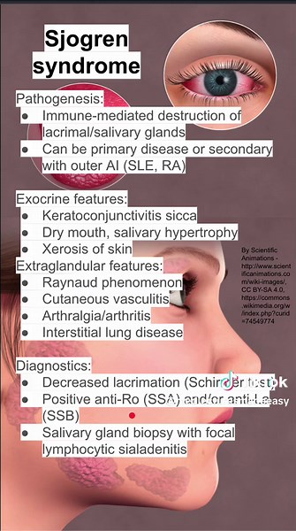 Sjogren syndrome - youtube.com/@MedLecturesMadeEasy