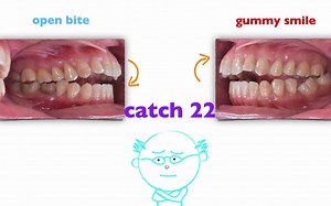 【Chris Chang Ortho】559. TADs application in open bite and gummy smile correction
