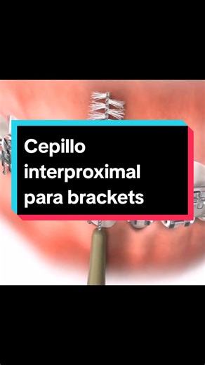 Uso del cepillo interproximal en ortodoncia