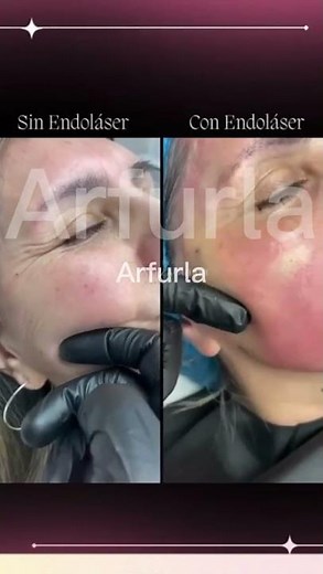 The 980nm and 1470nm dual-wavelength laser liposuction