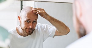 Los efectos secundarios del minoxidil, el medicamento que estimula el crecimiento de pelo y ralentiza la calvicie