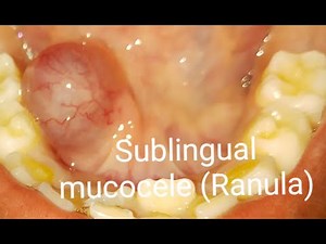 Sublingual mucocele ( Ranula) surgically removed by Laser
