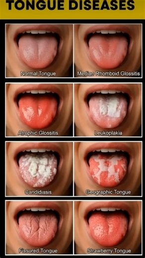 5.9K views · 13 reactions | Common Tongue Conditions and What They May Indicate #health #oralhealth #tonguehealth #medicaleducation #dentalhealth #healthawareness | 5 Minute Fitness Play | Facebook