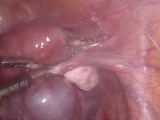 Triple Precision: Laparoscopic Excision of ACUM, Salpingectomy & Ovariotomy – Stepwise Surgical Video • Video • MEDtube.net