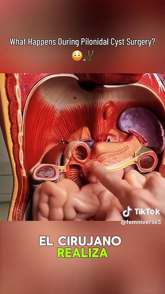 What Happens During Pilonidal Cyst Surgery? 😳🩺 #learnontiktok #educationalpurposesonly