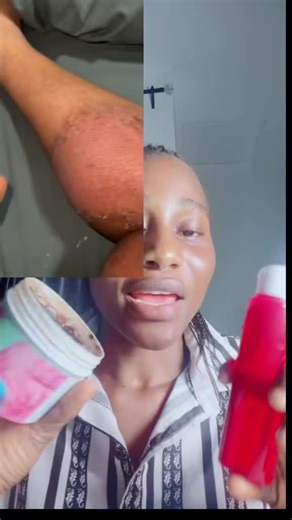 Effective Stretch Mark Removal with Peeling Gel and Soap