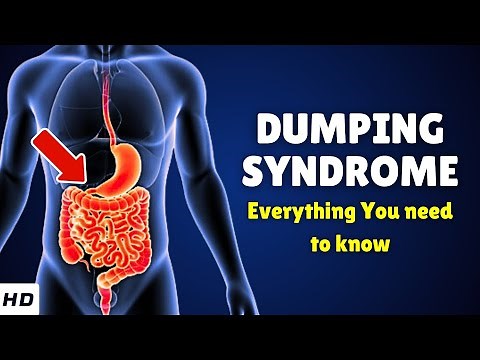 Dumping Syndrome – Types, Causes, Signs and Symptoms, Diagnosis & Treatment