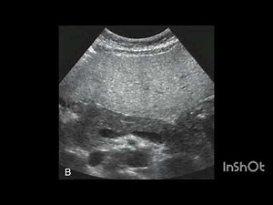 Diagnosing Fatty Liver Disease with Ultrasound: Hepatic Steatosis Explained
