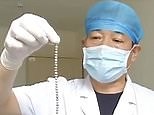 Chinese man has 29 magnetic beads stuck in bladder for over 10 days