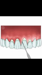 Tunnel technique is one of the most widspread procedures in muco gingival surgery. The objective when performing this technique is threefold : recession covering, thickness augmentation and tissue stabilisation. This 41-second video shows the basics of this approach. #daily_dentistry4 #dental #dentistry #dent #dentis #dentisani #dentalstudent #dentalstudents #dentalart #denti #den Взято у @daily_dentistry4 | All Dental / Вся стоматология