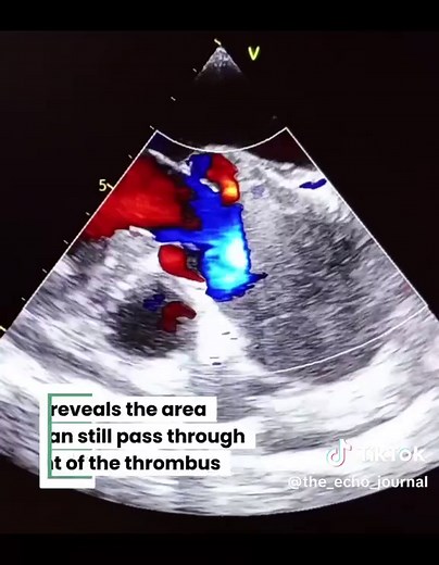 Ascending Aortic Thrombus 🔎 A rare but critical echocardiographic finding. Advance your adult echocardiography skills with The Echo Journal — practical education grounded in ASE guidelines and current research. Sign up on our website for free