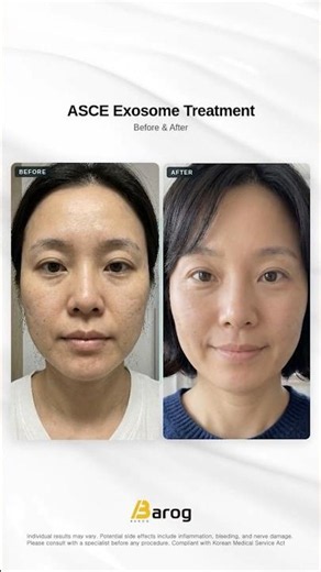 Miracle Recovery: ASCE Exosome Before & After ✨