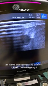 Your All-in-One IV Access Resource The NYSORA IV Access App offers everything you need: detailed visual guides, decision-making algorithms, and real-life video demonstrations. Whether you’re a beginner or an expert, enhance your precision, reduce complications, and improve outcomes with this essential tool. Get Started Today—Available on Google Play and the Apple App Store. | NYSORA - Continuing Medical Education