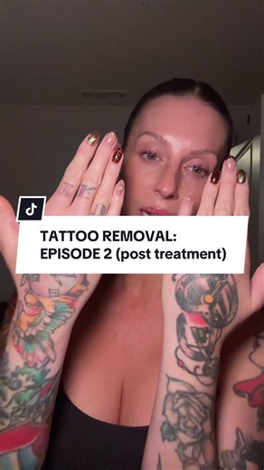Episode 2!!! @Removery Laser Tattoo Removal #removery #tattoos #tattooremoval #ad #fyp
