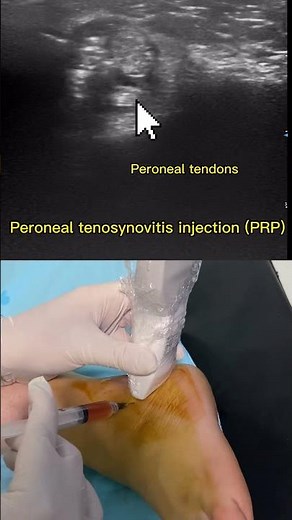 Peroneal tendon injection (PRP)